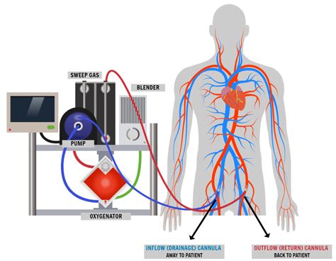 what is vva ecmo